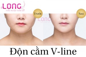 don-cam-v-line-danh-cho-doi-tuong-nao-1