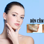 độn cằm bằng mỡ tự thân