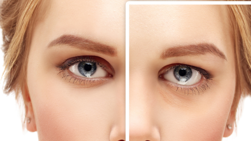 cắt da thừa mí mắt dưới