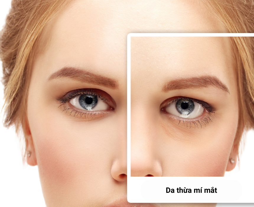 cắt da thừa mí mắt dưới