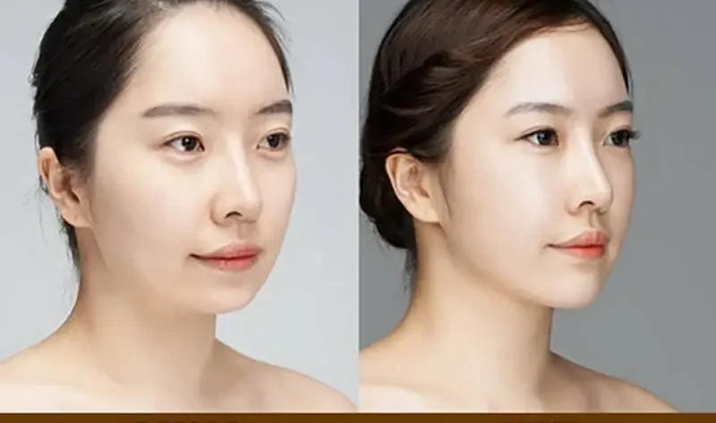 độn cằm rồi có lấy ra được không