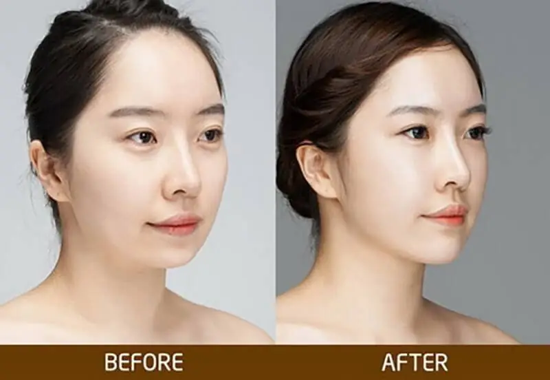 độn cằm rồi có lấy ra được không