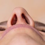 nâng mũi làm hẹp lỗ mũi