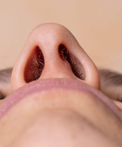 nâng mũi làm hẹp lỗ mũi