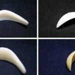 sụn độn cằm