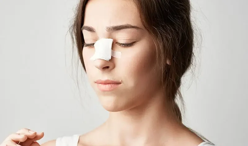 Nâng sống mũi bị sưng bao lâu thì lành