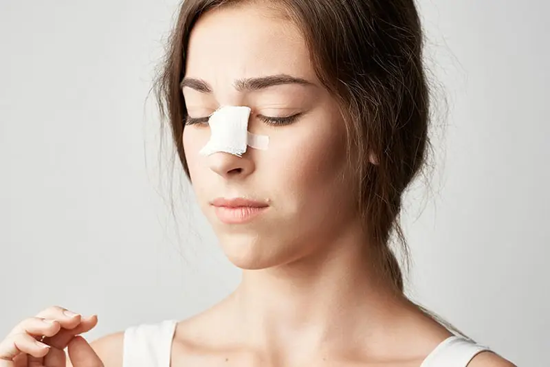 Nâng sống mũi bị sưng bao lâu thì lành