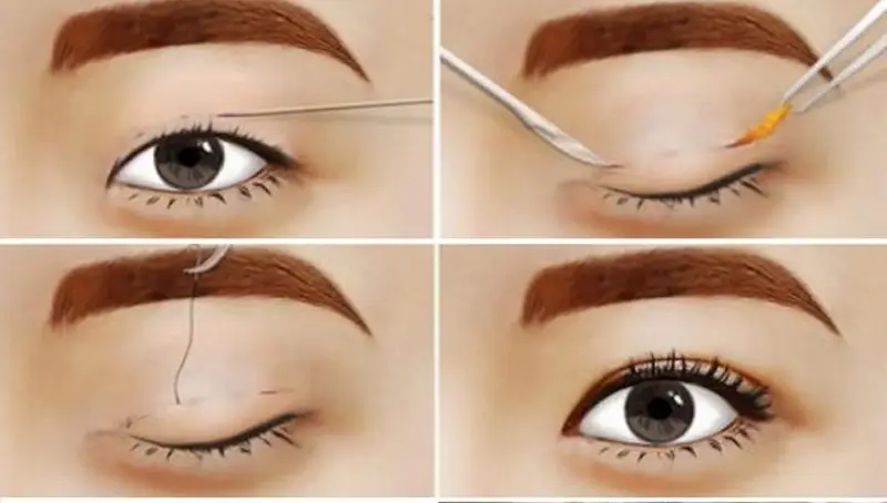 bấm mí và cắt mí khác nhau thế nào