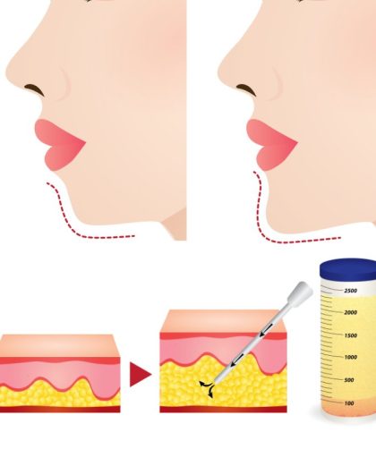cay-mo-cam-giai-phap-toi-uu-cho-cam-thon-gon-tu-nhien-khong-xam-lan