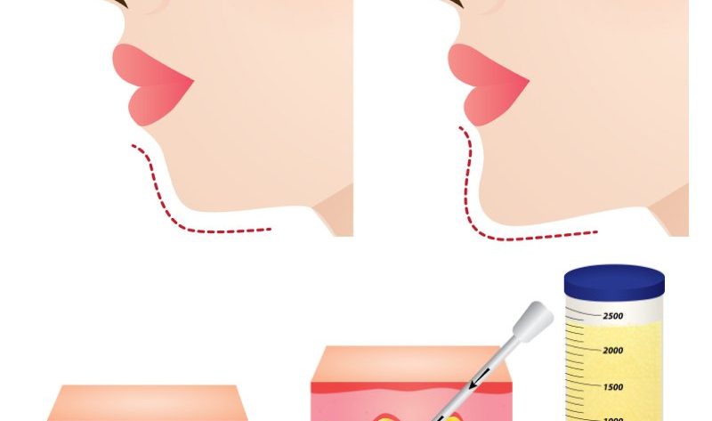 cay-mo-cam-giai-phap-toi-uu-cho-cam-thon-gon-tu-nhien-khong-xam-lan