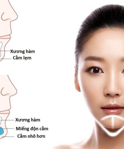 độn cằm có tác dụng gì