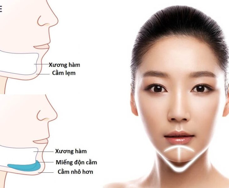 độn cằm có tác dụng gì