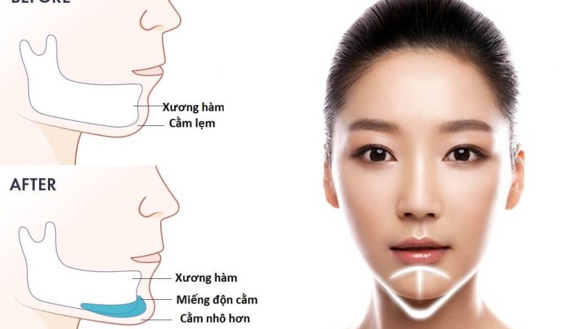 độn cằm có tác dụng gì