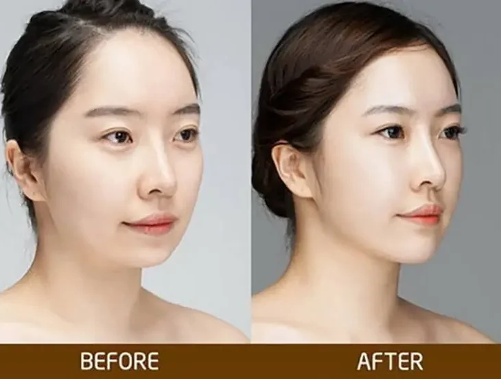 độn cằm rồi có lấy ra được không