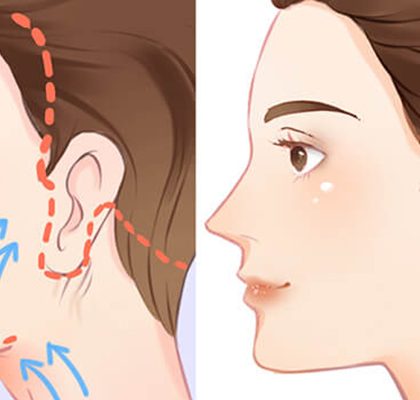 Phẫu thuật căng da mặt giữ được bao lâu và cách duy trì lâu nhất