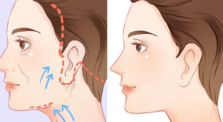 Phẫu thuật căng da mặt giữ được bao lâu và cách duy trì lâu nhất