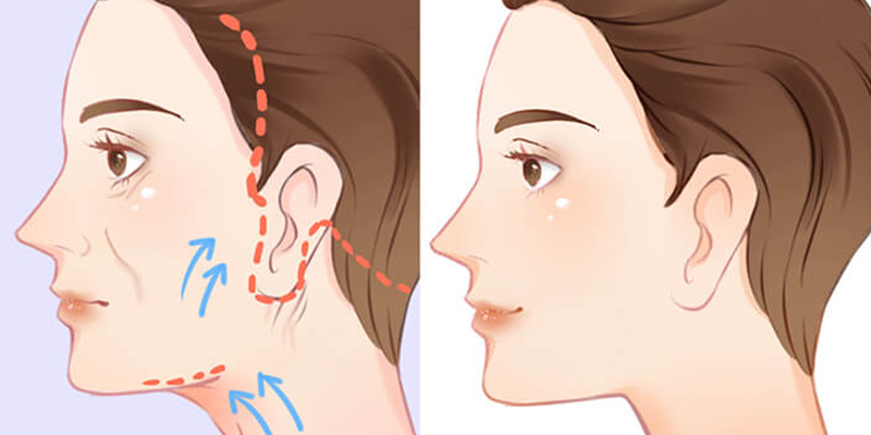 Phẫu thuật căng da mặt giữ được bao lâu và cách duy trì lâu nhất